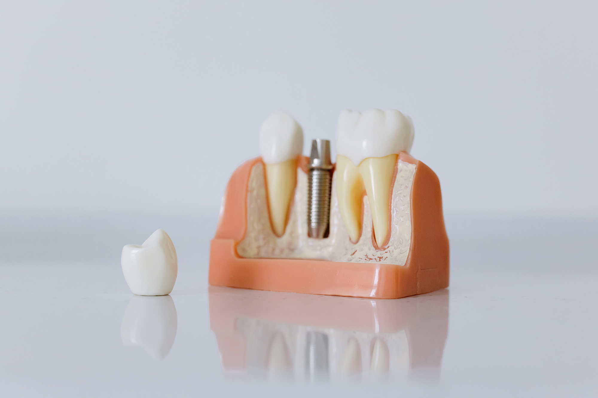 How Much Do Dental Implants Cost in Australia? The Dentist at 70 Pitt St