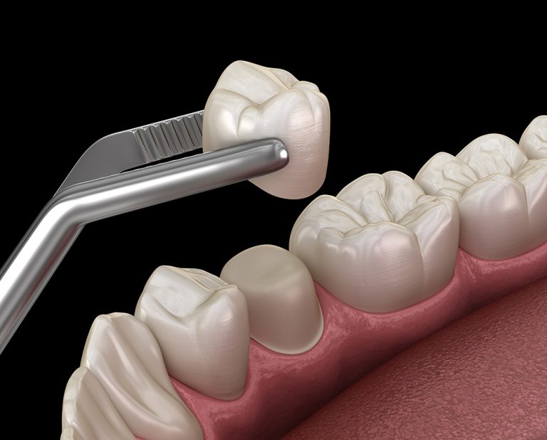 Crowns Vs Veneers: Understanding their Differences