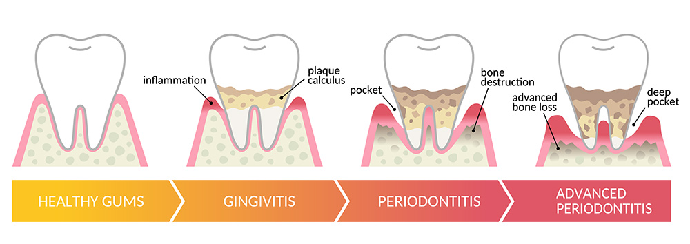 Plaque on Teeth | How to Get Rid of Plaque on Teeth | What is Plaque on Teeth