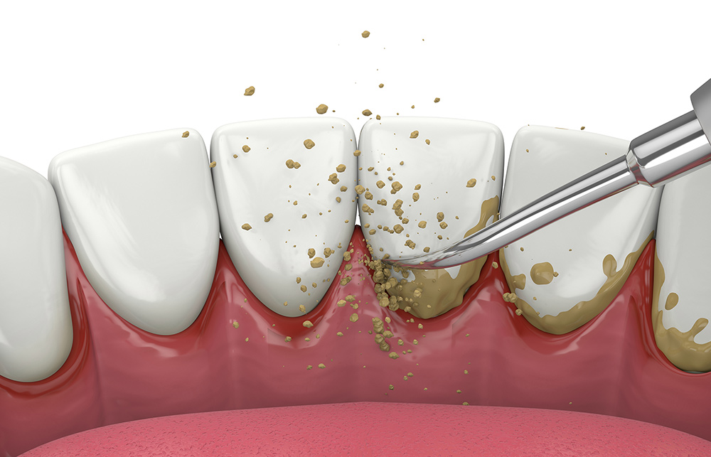 Plaque on Teeth | What Causes Plaque on Teeth | What is Plaque Made Of